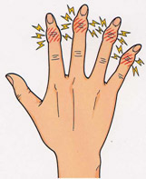 女性にみられる指の変形性関節症