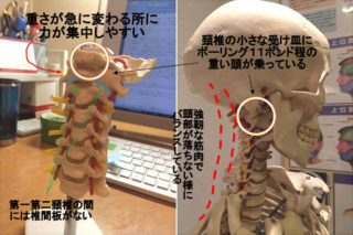 交通事故とむち打ち損傷