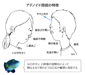 アデノイド顔貌の特徴